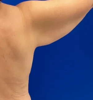 02-B-arm-lift-preview