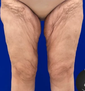 02-B-body-contouring-preview