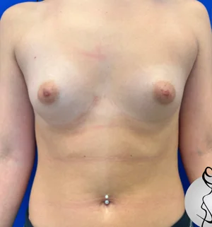 02-B-breast-aug-preview