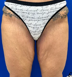 02-B-thigh-lift-preview