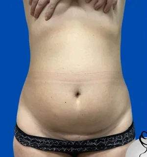 02-B-tummy-tuck-preview