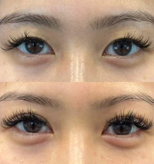 02-asian-eyelid-preview