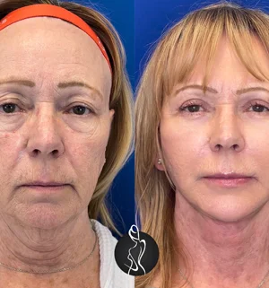 02-face-lift-preview