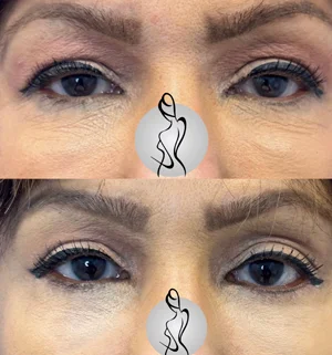 02-lower-eyelids-preview