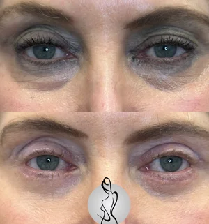 02-upper-eye-preview