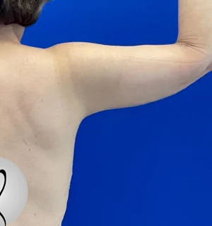 03-A-arm-lift-preview