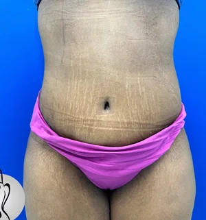 03-A-body-contouring-preview
