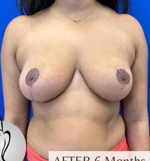 03-A-breast-redu-preview