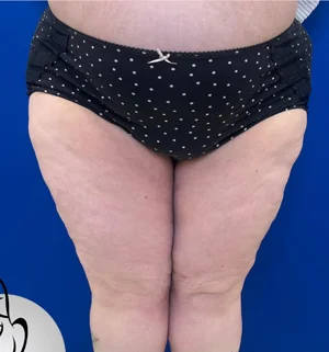 03-A-thigh-lift-preview