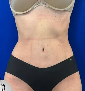 03-A-tummy-tuck-preview