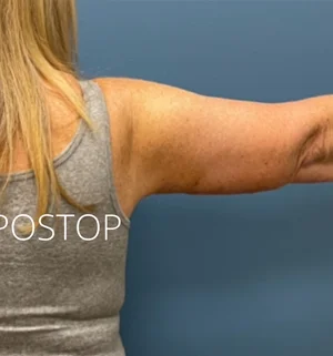 03-B-arm-lift-preview