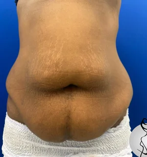 03-B-body-contouring-preview