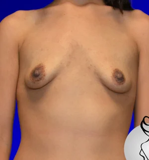 03-B-breast-aug-preview