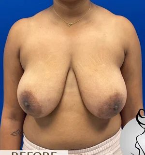 03-B-breast-redu-preview