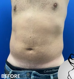 03-B-male-plastic-preview