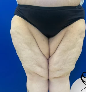 03-B-thigh-lift-preview