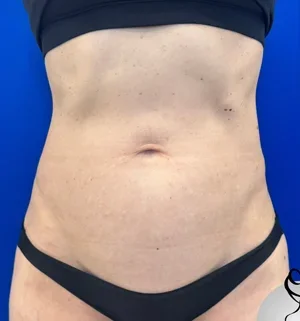 03-B-tummy-tuck-preview