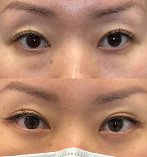 03-asian-eyelid-preview