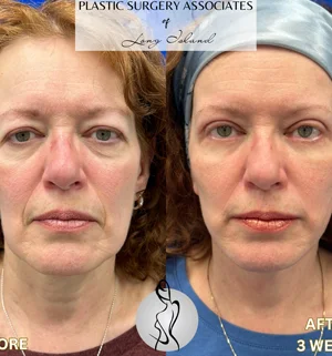 03-face-lift-preview