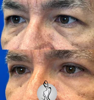 03-lower-eyelids-preview