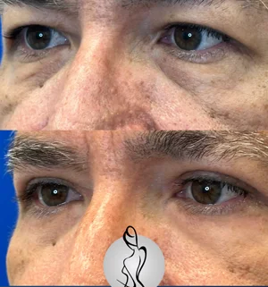 03-upper-eye-preview