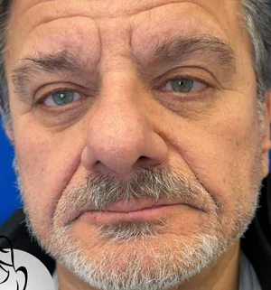 04-A-upper-eye-preview