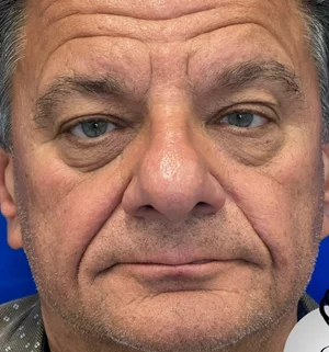 04-B-upper-eye-preview