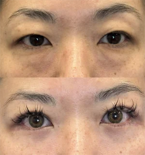 04-asian-eyelid-preview