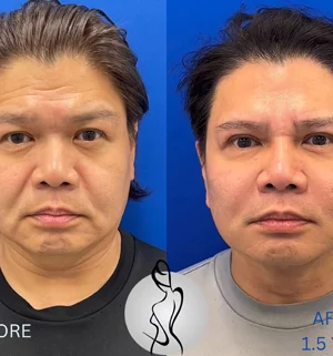 04-face-lift-preview