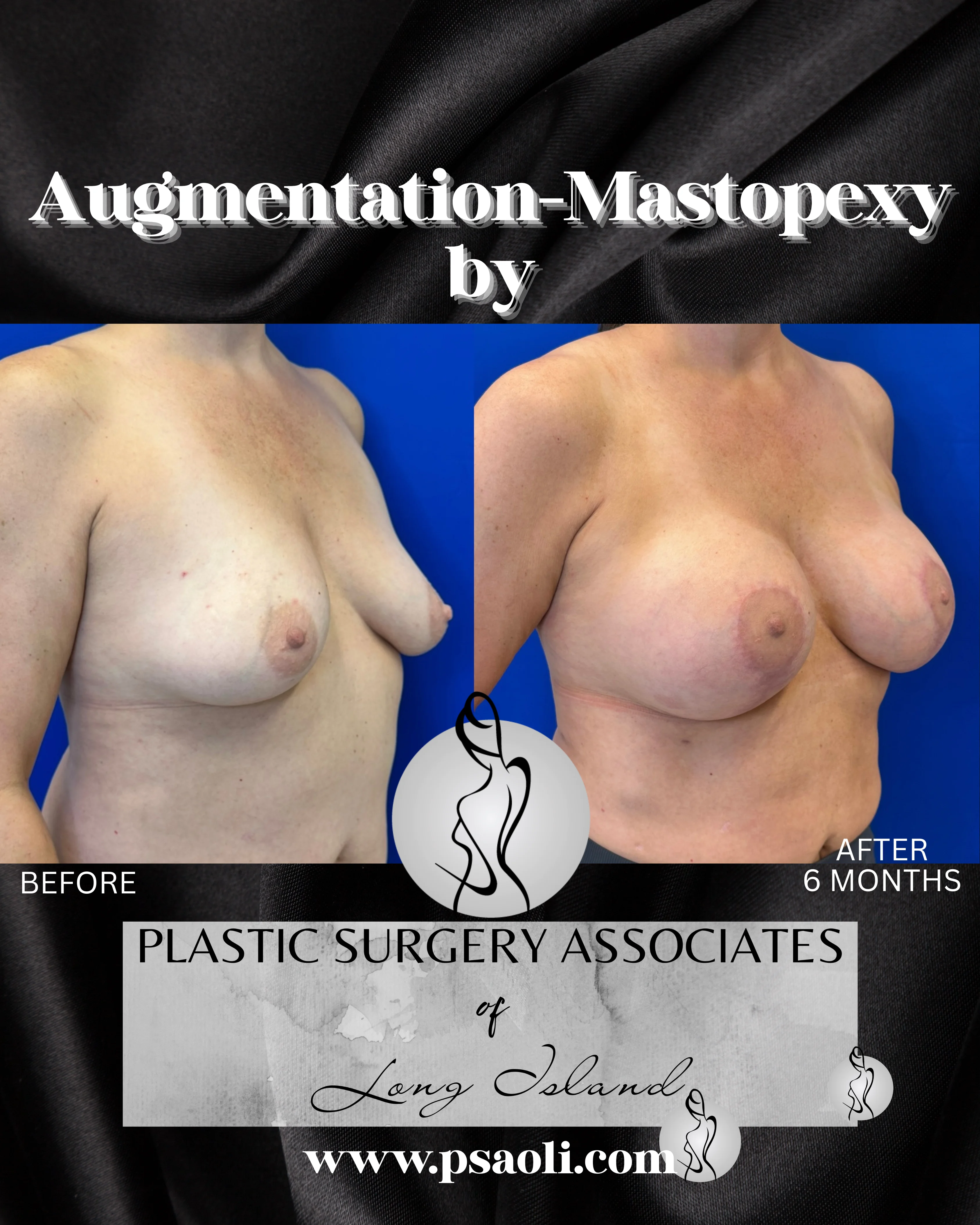 Augmentation-Mastopexy – 2
