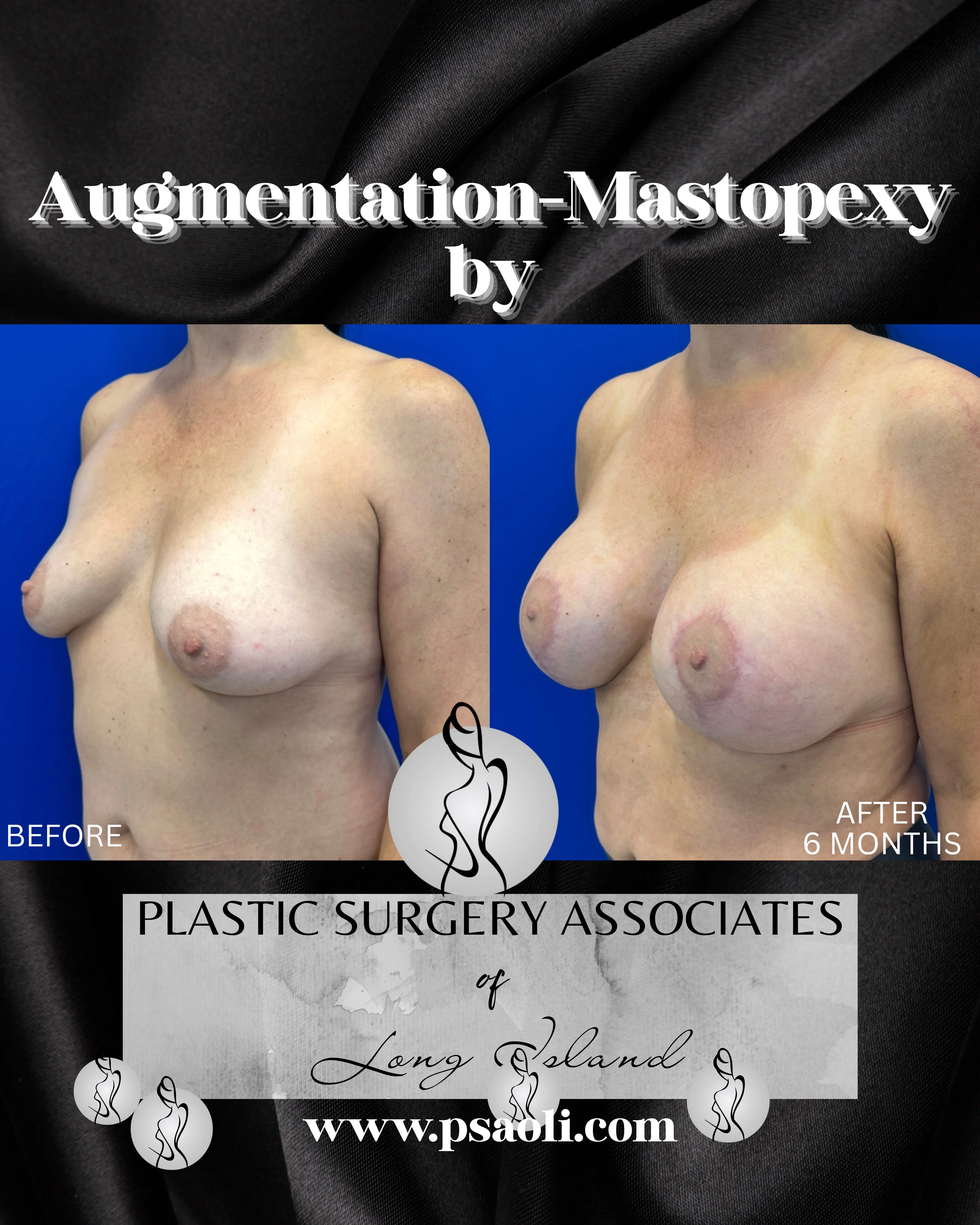 Augmentation-Mastopexy – 3