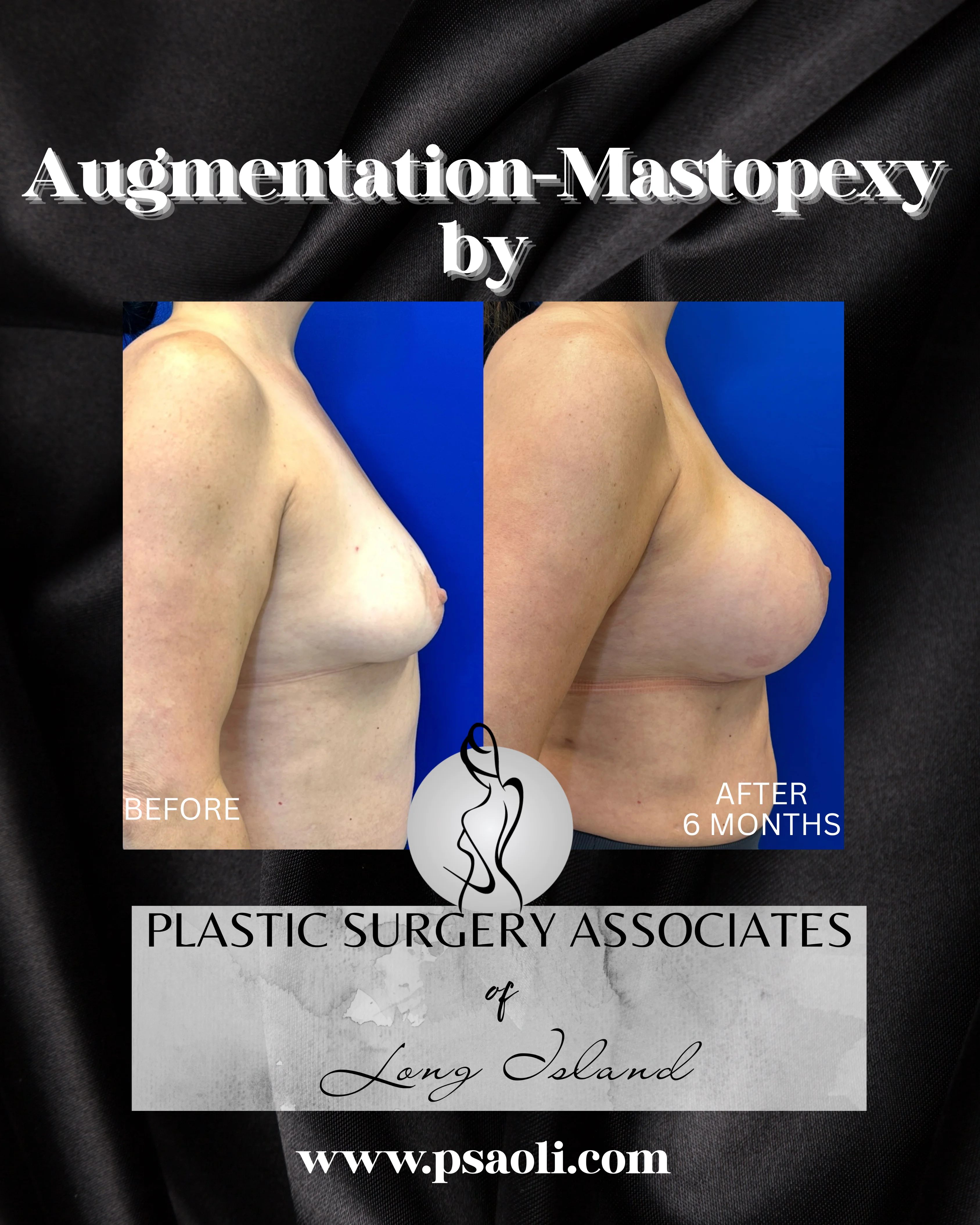 Augmentation-Mastopexy – 4