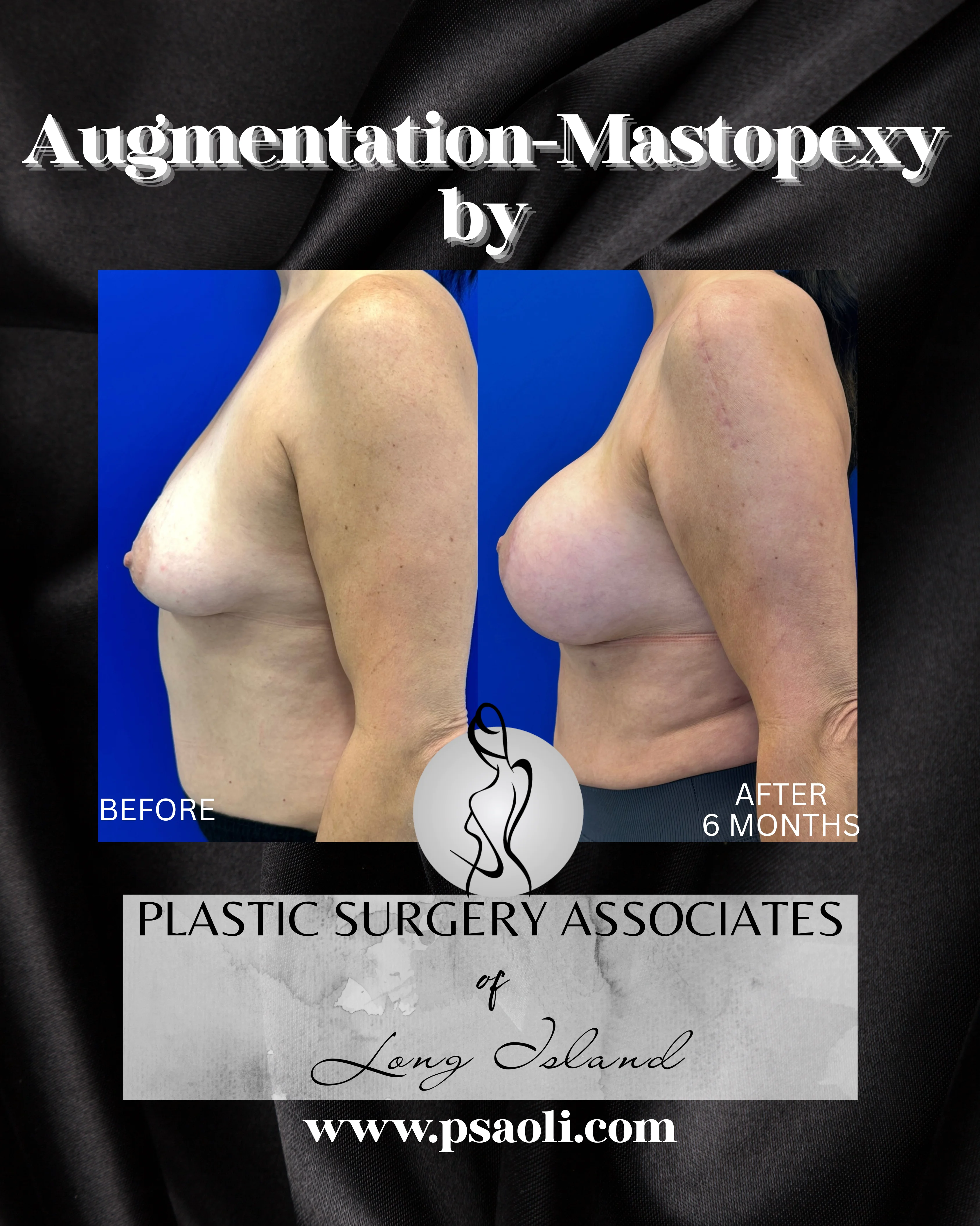 Augmentation-Mastopexy – 5