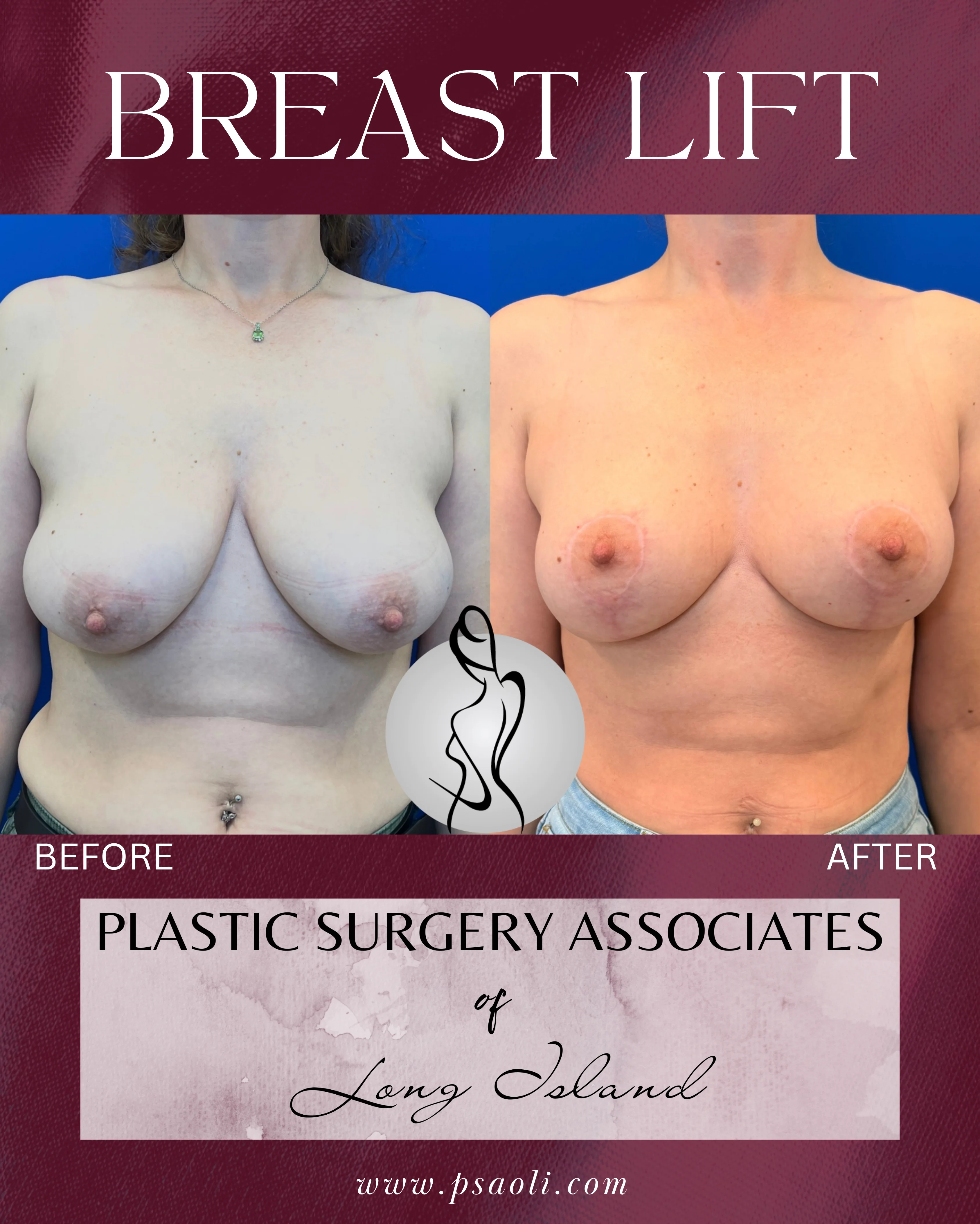 BREAST LIFT – 1