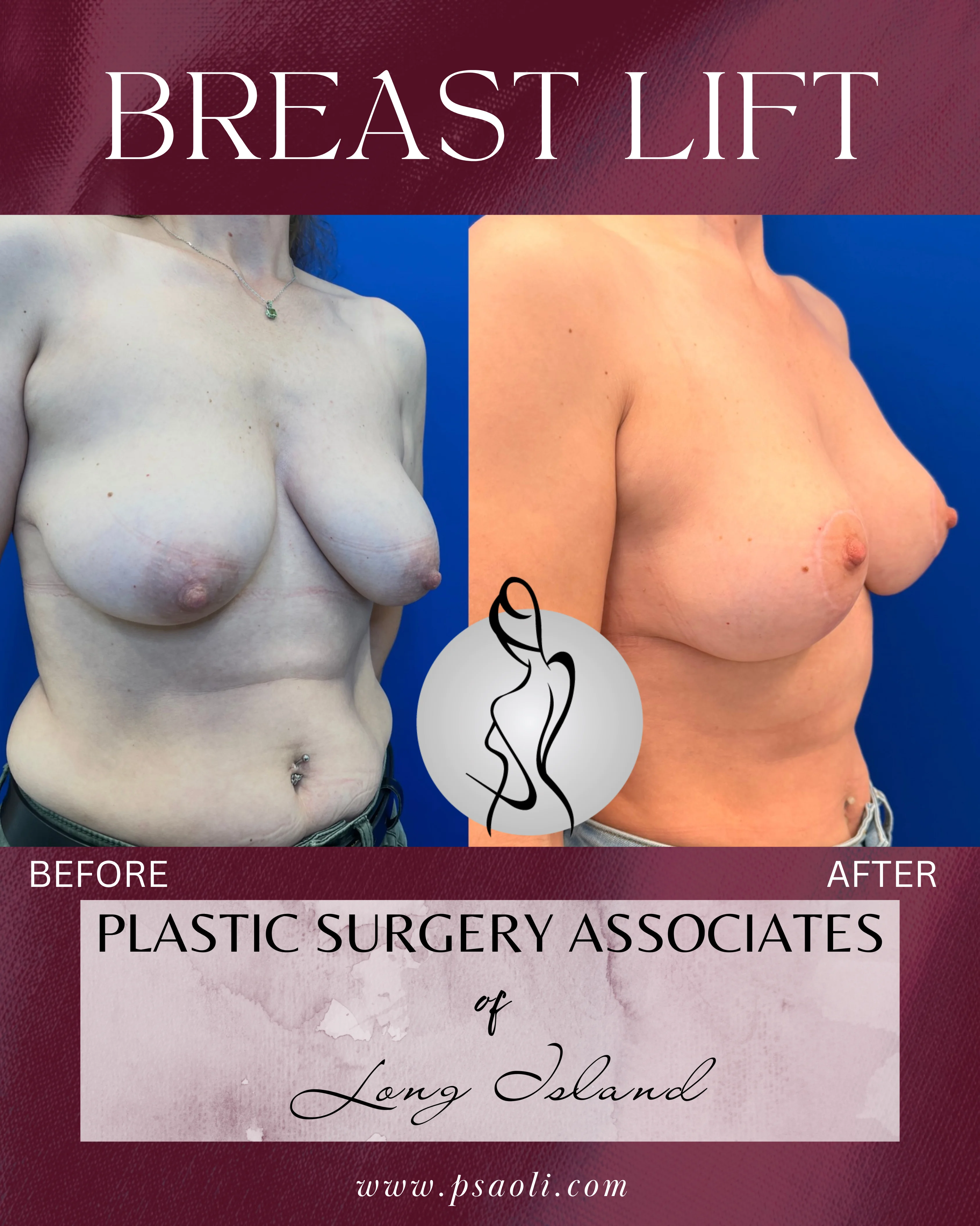 BREAST LIFT – 2