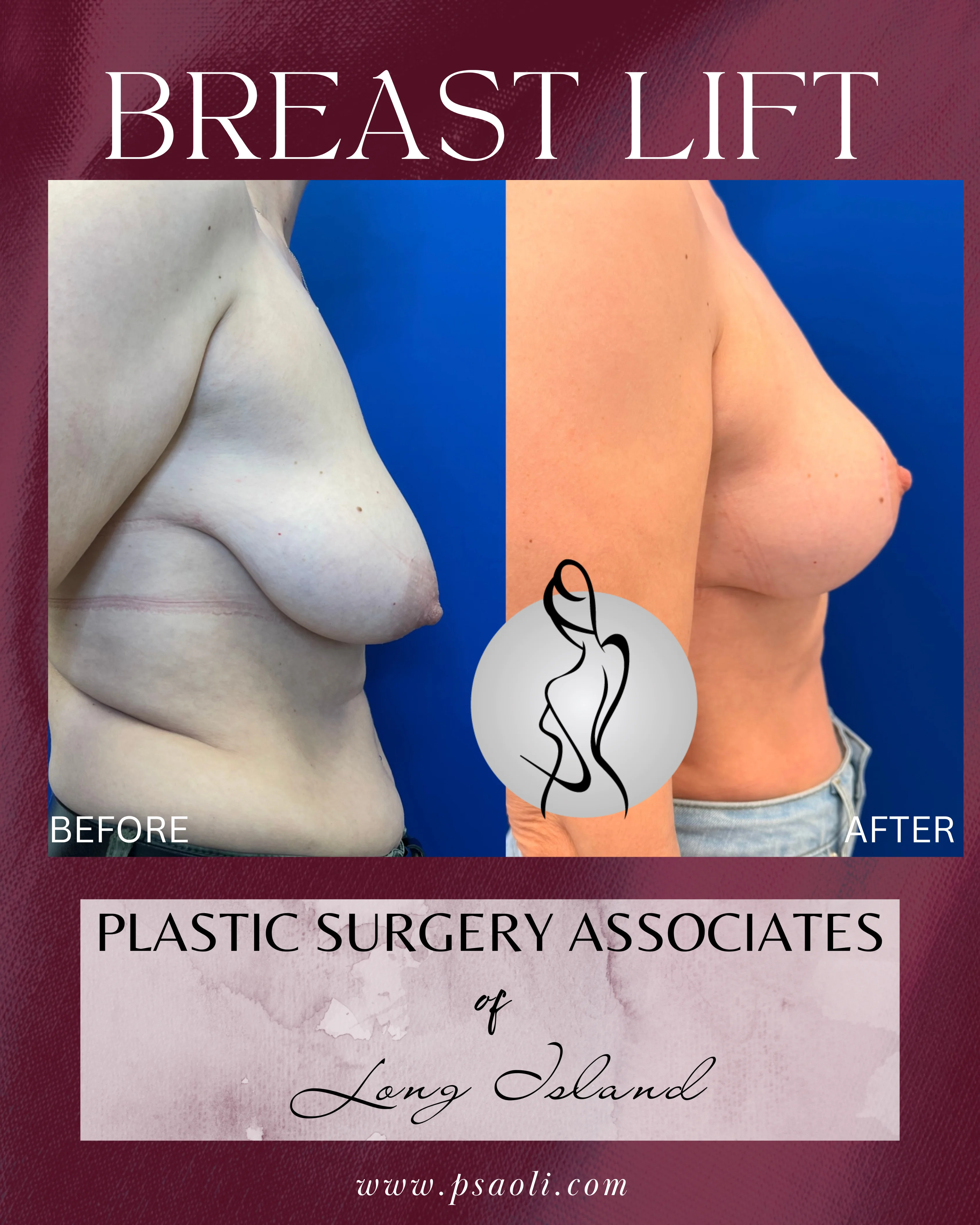 BREAST LIFT – 3