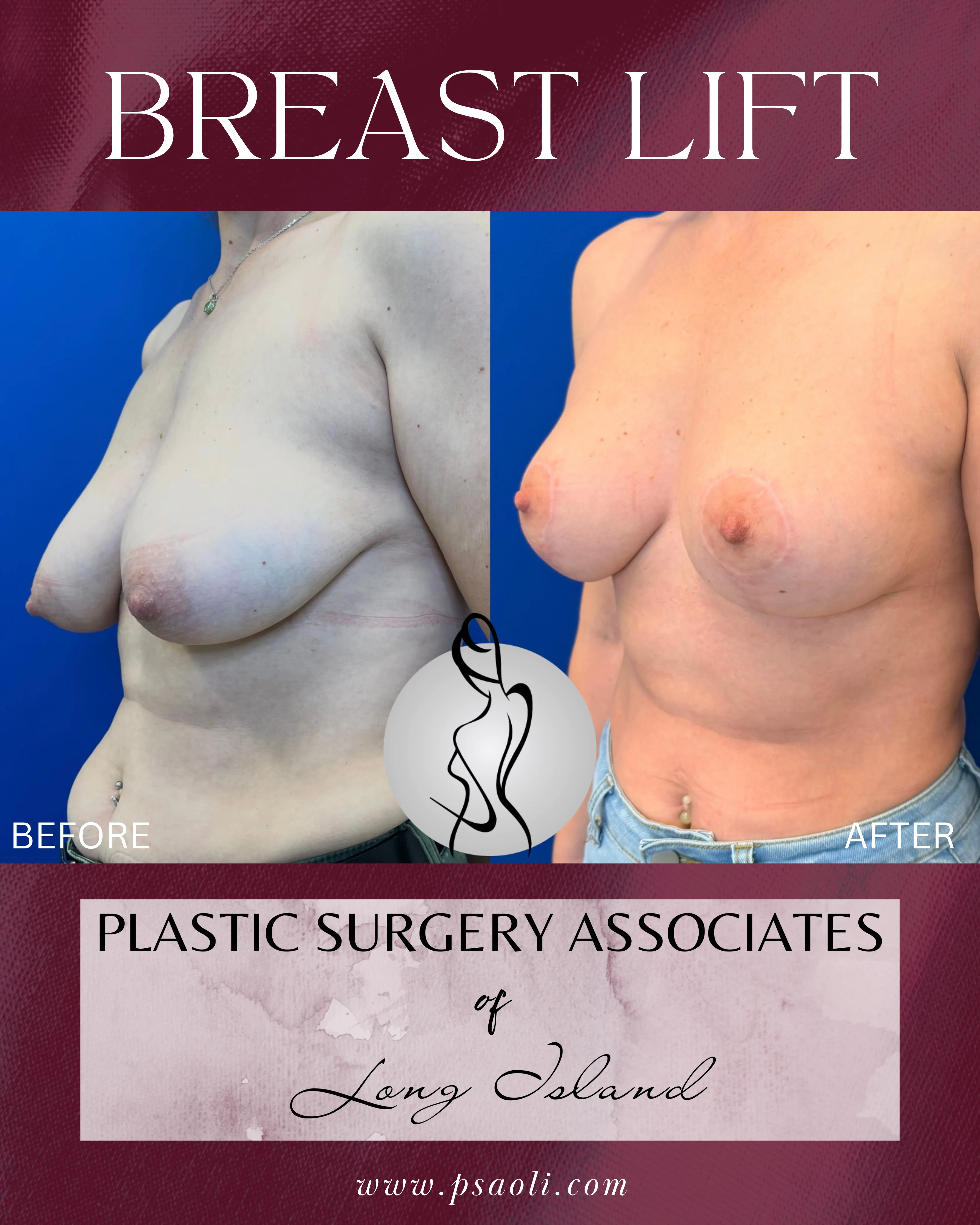BREAST LIFT – 4