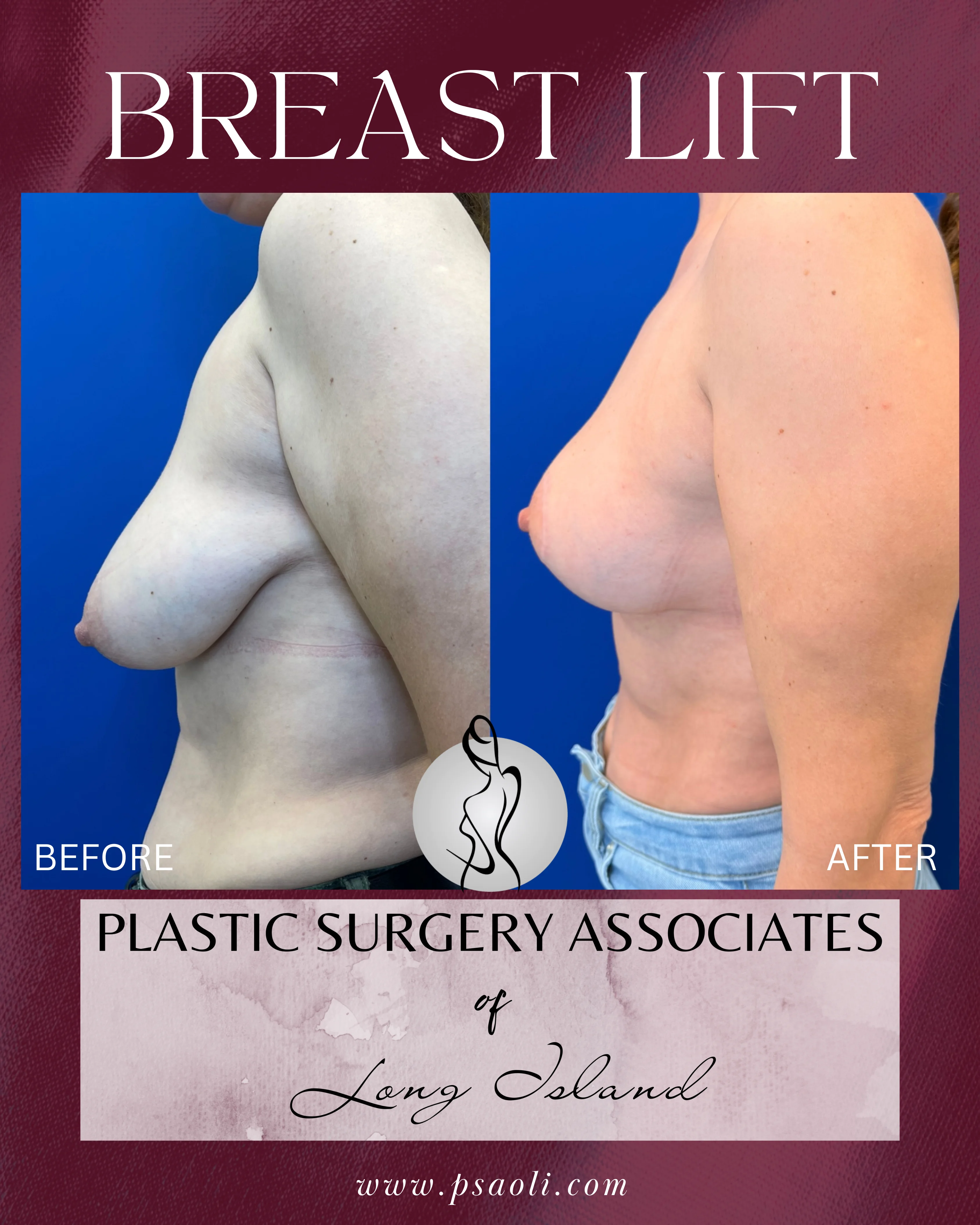 BREAST LIFT – 5