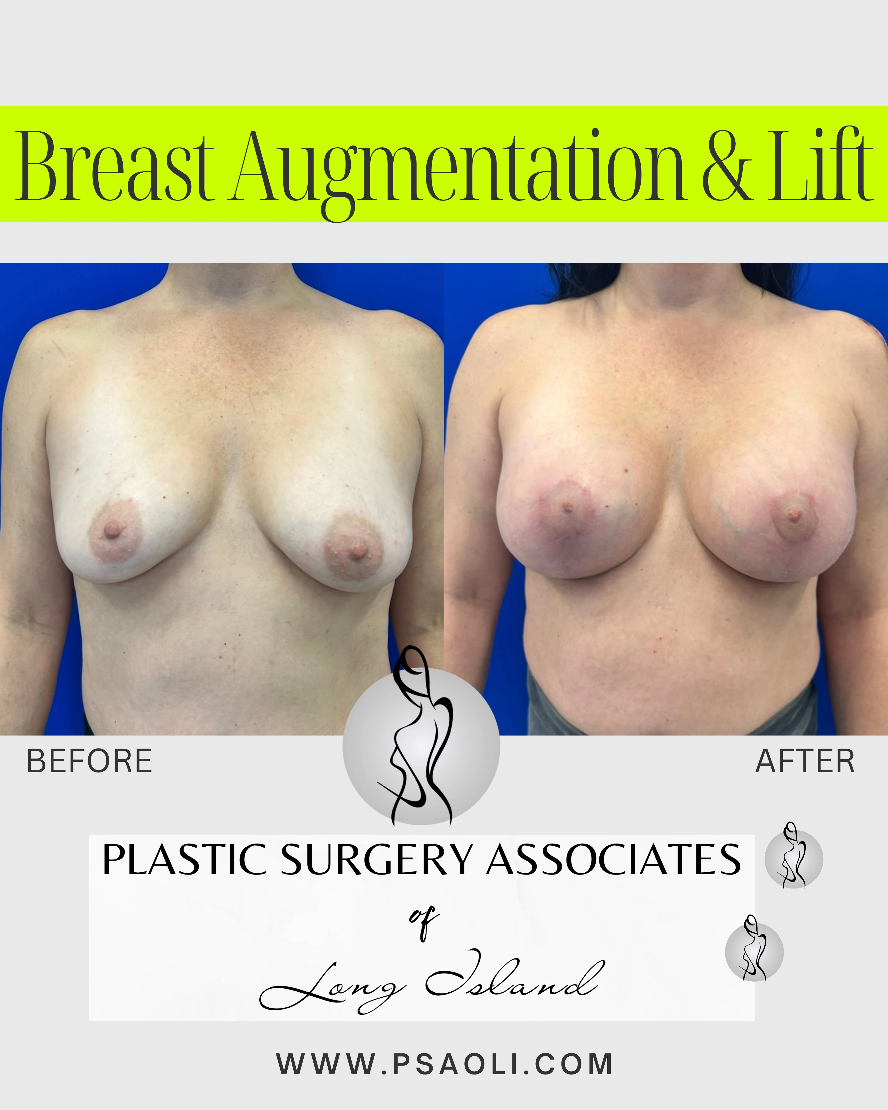 Breast Augmentation & Lift – 1
