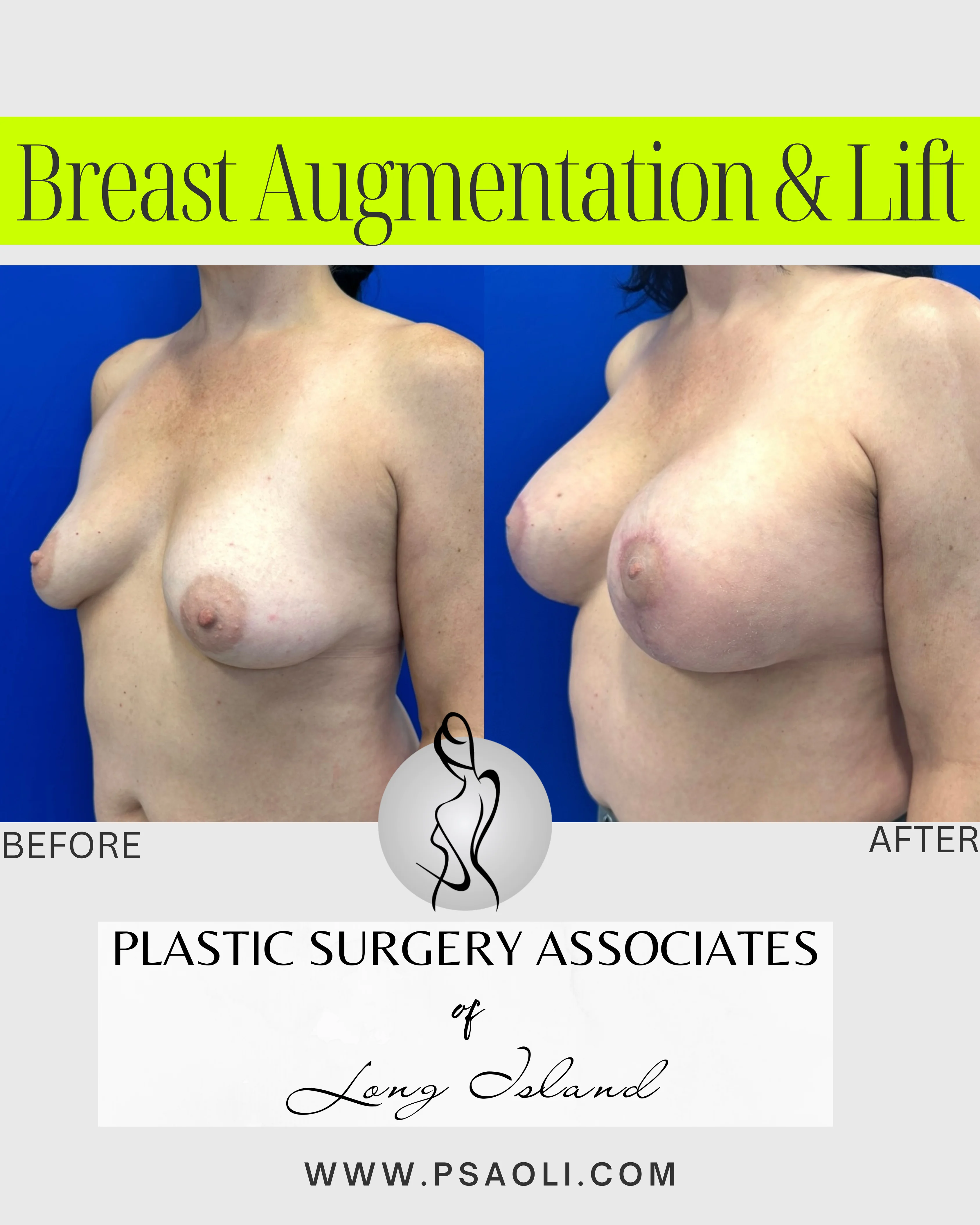 Breast Augmentation & Lift – 2