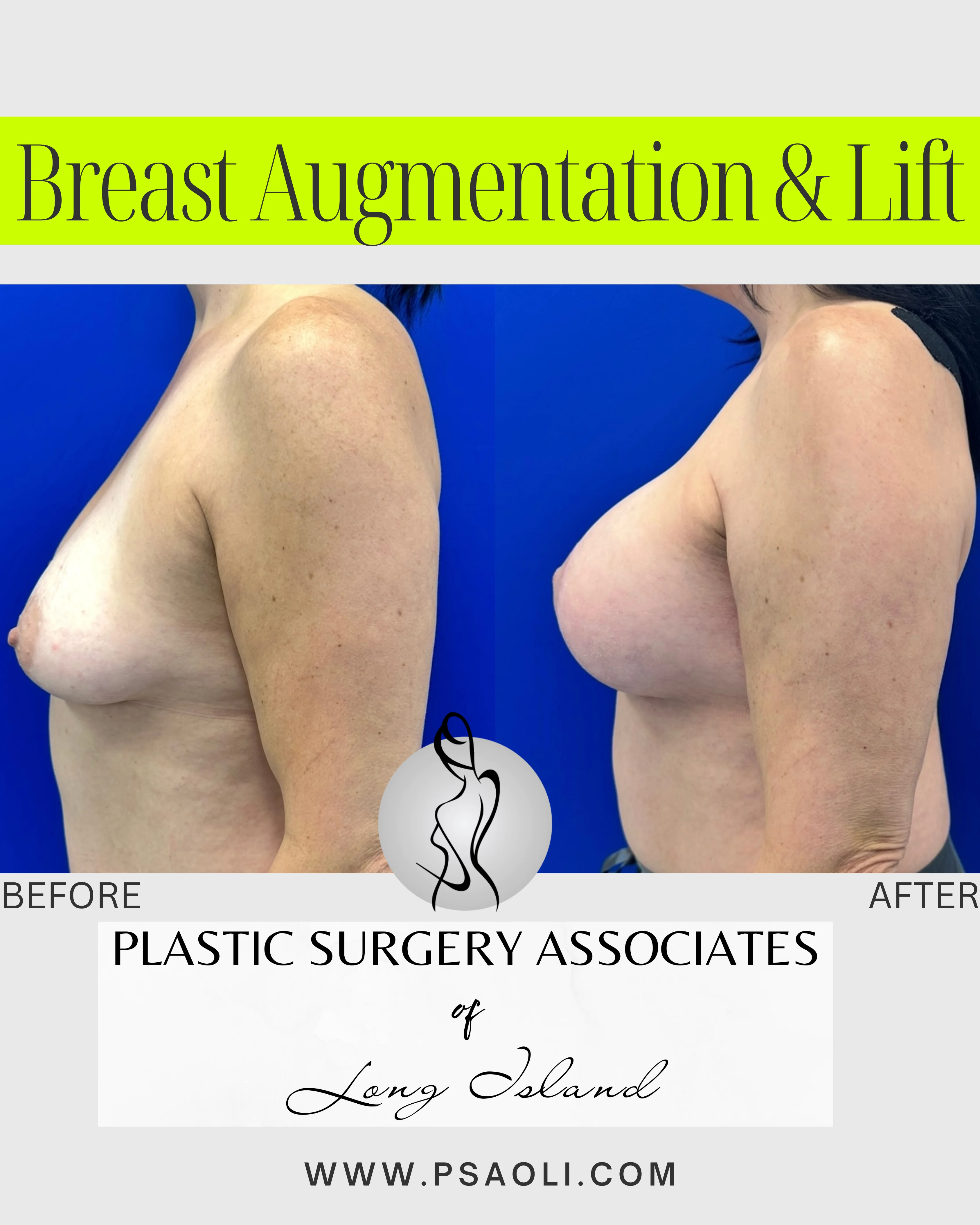 Breast Augmentation & Lift – 3