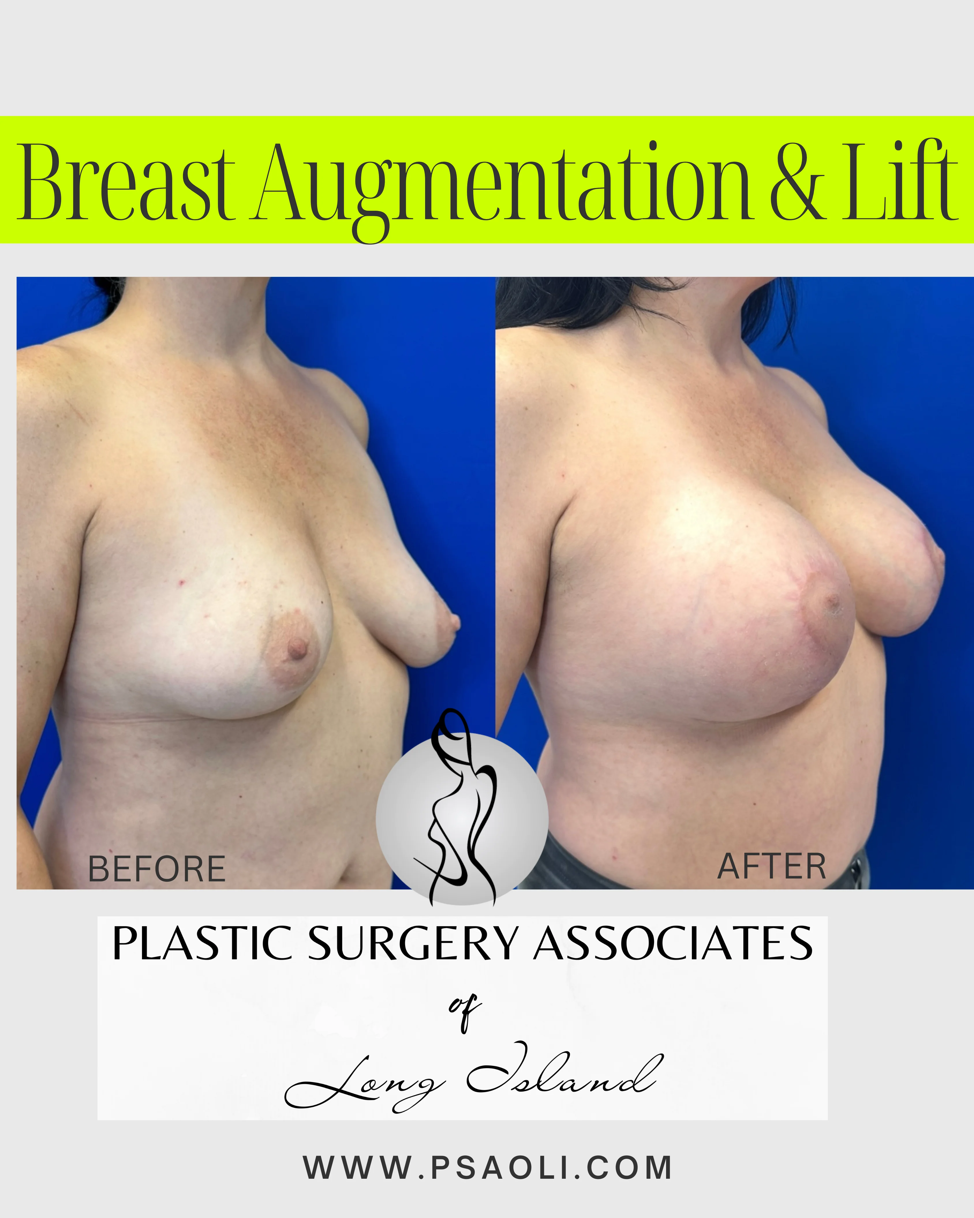 Breast Augmentation & Lift – 4
