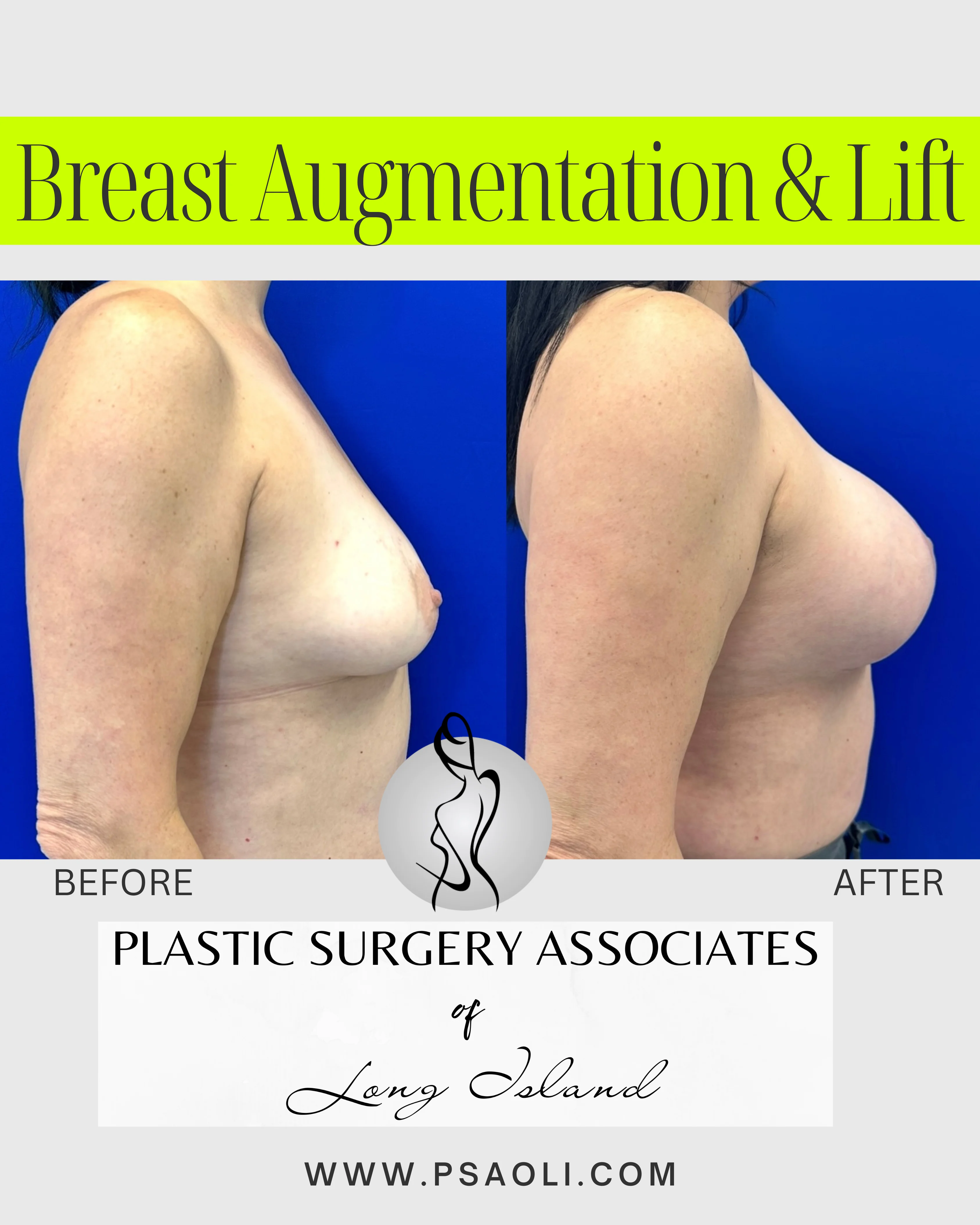Breast Augmentation & Lift – 5
