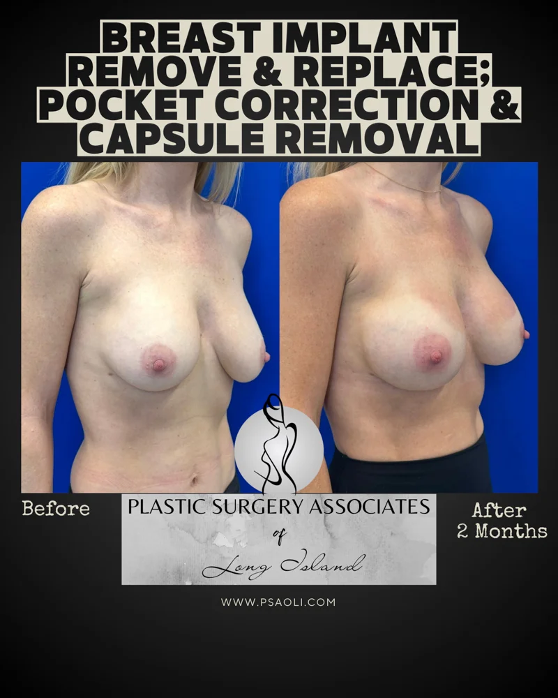 Breast Implant remove & replace_ pocket correction and capsule removal – 3