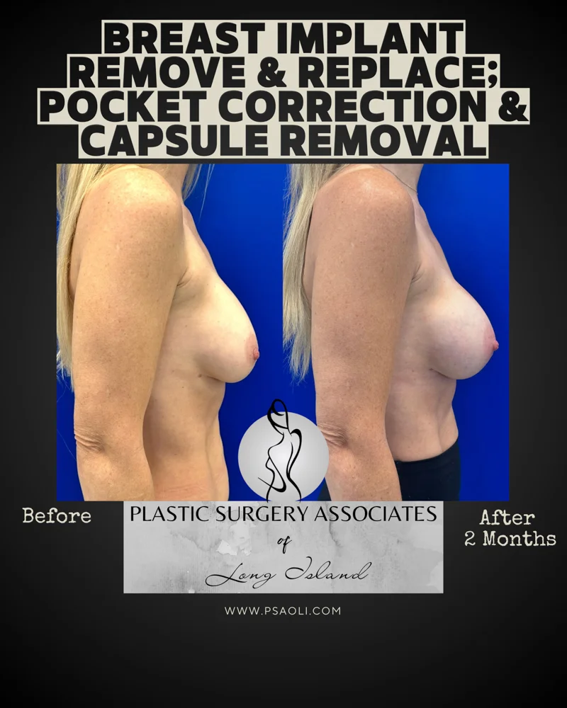Breast Implant remove & replace_ pocket correction and capsule removal – 4