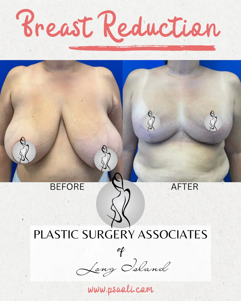 Breast Refuction – 1