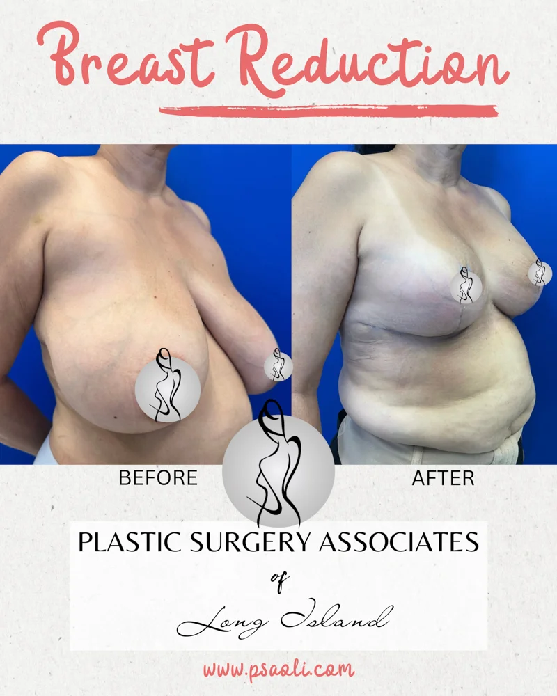 Breast Refuction – 2