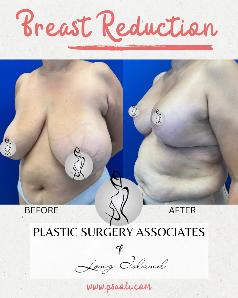 Breast Refuction – 3