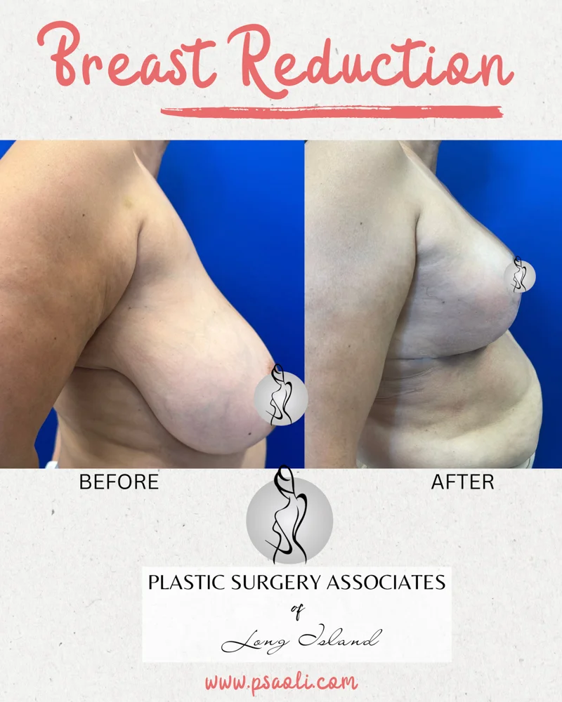 Breast Refuction – 4