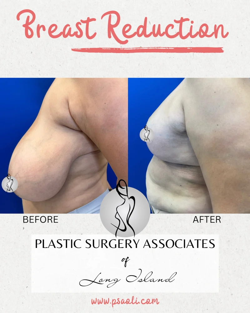 Breast Refuction – 5